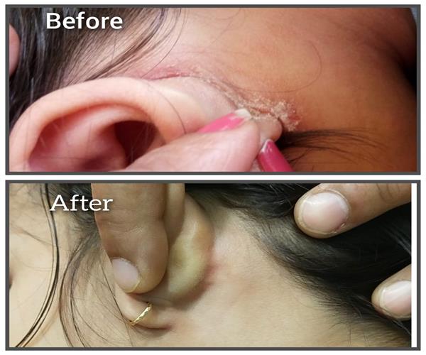 Case of fungal infection behind ear Shreeda Homeopathy Clinic Vaishnodevi Ahmedabad Gujarat india.