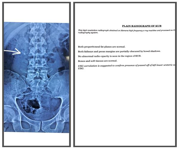 Case of kidney stone Shreeda Homeopathy Clinic Vaishnodevi Ahmedabad Gujarat india